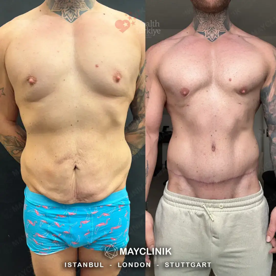 daddy makeover turkey tummy tuck