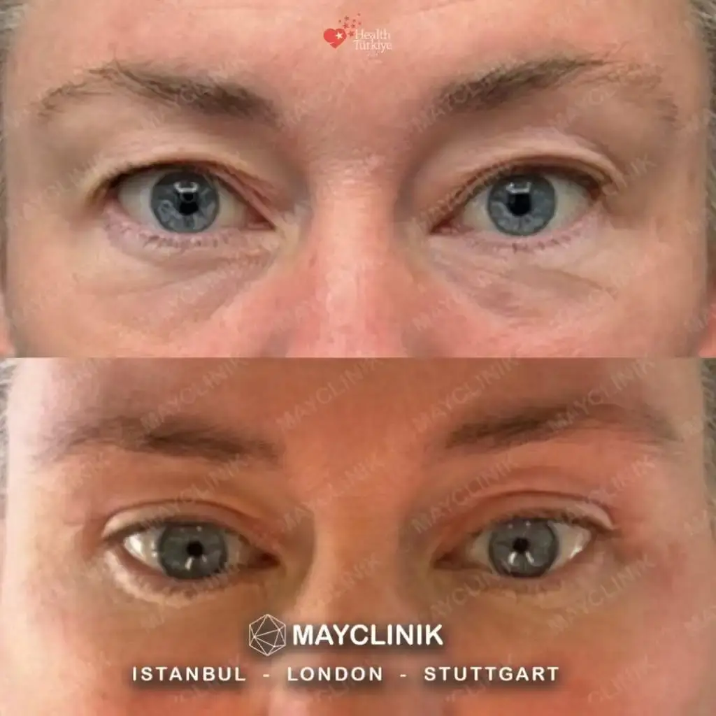 upper eyelid before after 1