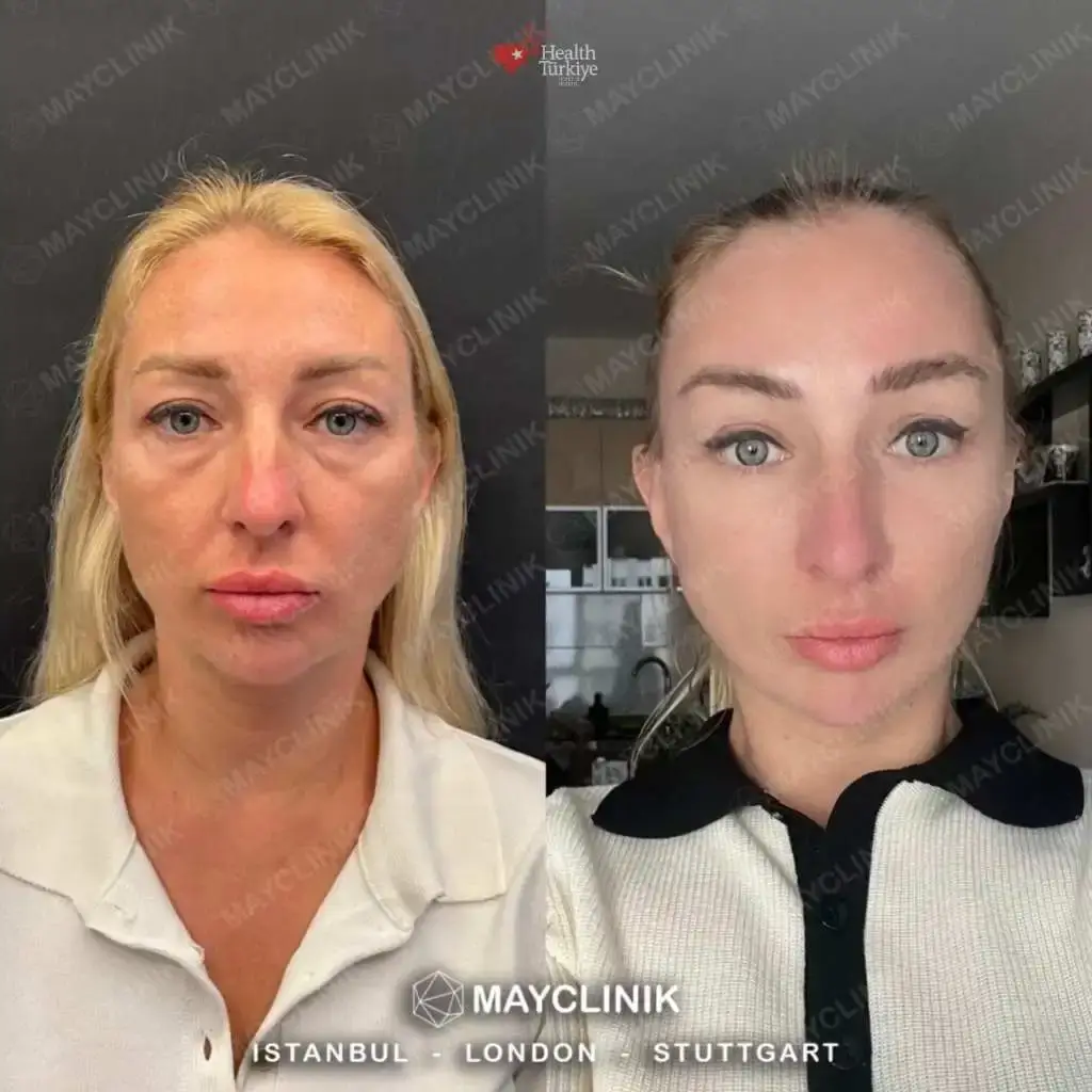 upper eyelid before after 2