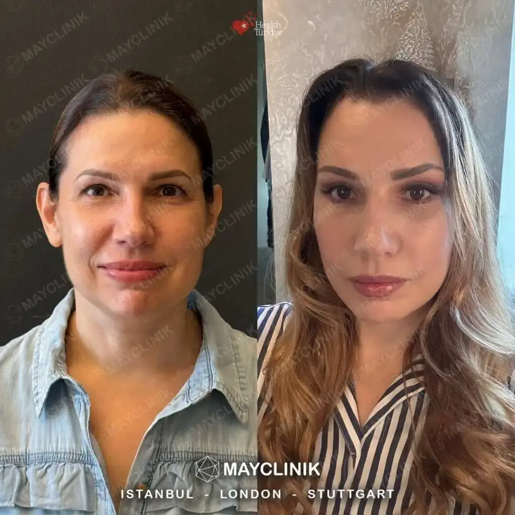 upper eyelid before after 3
