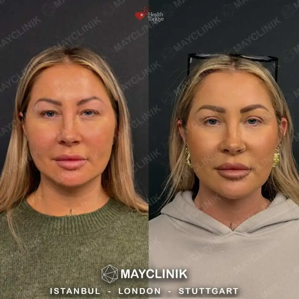 upper eyelid before after 4