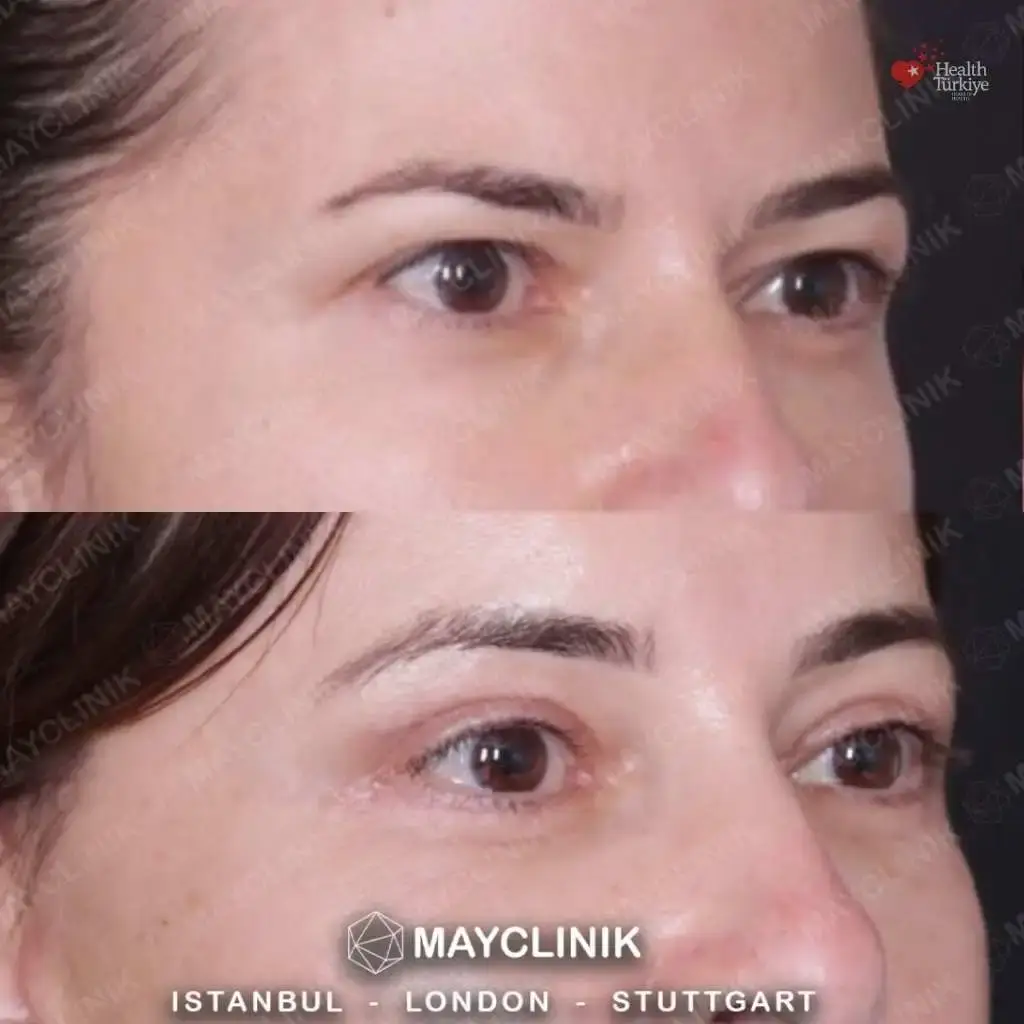upper eyelid before after 5